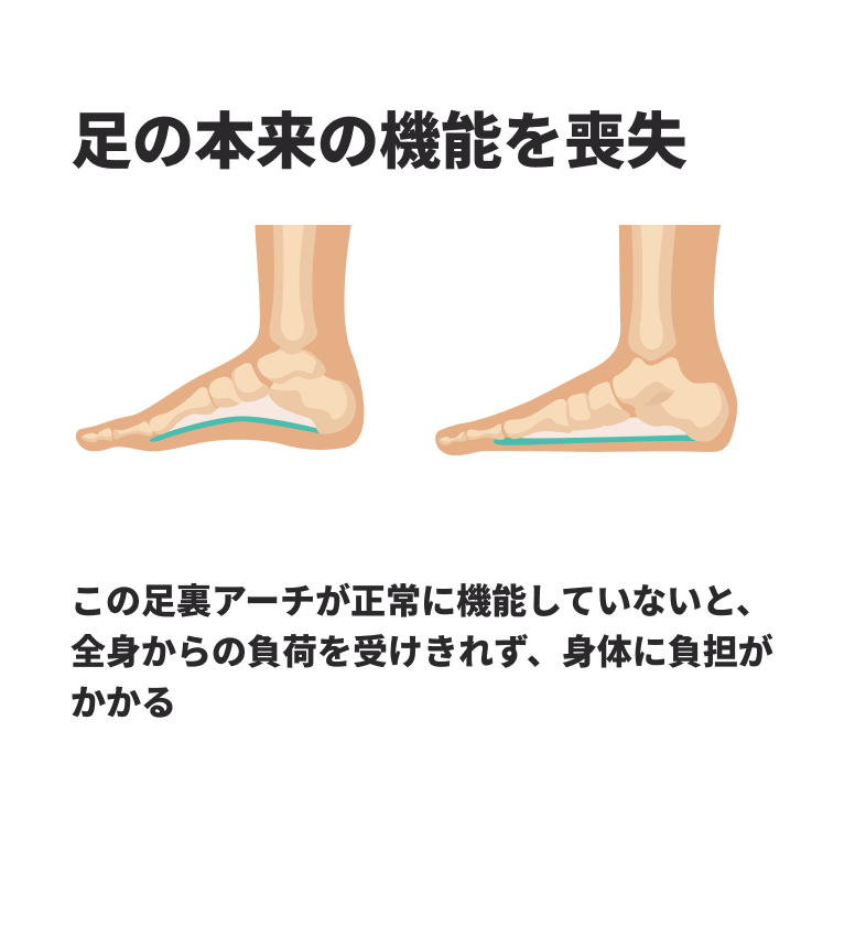 アーチ構造が崩れ、足の本来の機能を喪失 この足裏アーチが正常に機能していないと、全身からの負荷を受けきれず、身体に負担がかかる